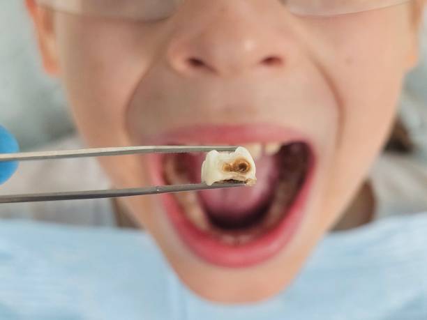 Best Emergency Treatment for Dental Infections or Abscesses in Panama, OK
